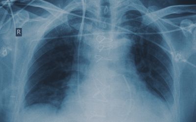 New Study by Dr. Frank Sciurba et al. Shows Promising Results for COPD Treatment